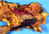 Pancreaticoduodenectomy specimen