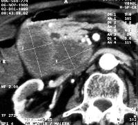 CT after contrast medium administration