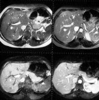 MR study of the pancreas: normal anatomy