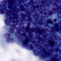 Honeycomb appearance of the ductal cells from a case of chronic pancreatitis.