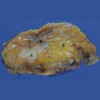 The cut surface demonstrated diffuse fatty infiltration and contained a well-demarcated white to grayish tumor