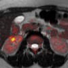 Fusion of axial MRI T2-weighted spin-echo and diffusion-weighted image showing complete resolution of the pancreatic lesions and dramatic regression of the right kidney lesion