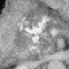 CECT abdomen showing calcification in the head of the pancreas