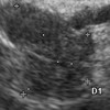 Endoscopic ultrasonic image of the pancreatic neck lesion
