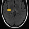 Bilateral and symmetrical hyperintense lesions in pulvinar and dorsomedial thalami