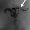 Successful occlusion of the splenic artery branch with metal coils
