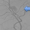 Right intra-hepatic artery pseudoaneurysm