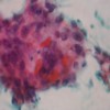 Cytology smear showing large, pleomorphic mononucleated cells having large, hyperchromatic, pleomorphic nuclei