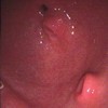 Endoscopic image of double heterotopic pancreatic tissue in antrum