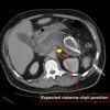 CT abdomen showing haemorrhagic pancreatitis with drain in situ.
