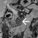 A clear-cut margins lesion in the pancreatic head