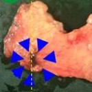 Resection of the transverse mesocolon