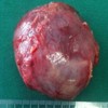 Enucleated tumor, with fibroelastic consistence