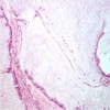 Microscopic histopathological examination of the surgical specimen showed the characteristic pools of mucin