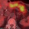 Fused axial PET/CT image reveals the hypermetabolic pancreatic malignancy