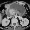 Axial CT image demonstrating pseudocyst formation
