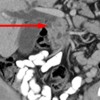 Coronal CT with arrow illustrating deleted cystic changes of duodenal wall and intra and extra hepatic dilatation