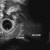 Radial endosonography demonstrates a 1.5 cm, oval shaped, homogeneous, hypoechoic lesion with sharp, well defined borders in the tail of the pancreas and has similar echogenicity of the spleen