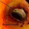Enteroscope view demonstrating the hepatico-jejunal anastomosis and the intra-hepatic bile duct