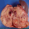 The macroscopic appearance of the resected tumor