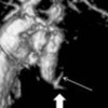 Two pancreatic ducts, ventral duct (thick arrow) having shorter length compared to dorsal duct (thin arrow)