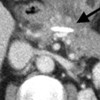 Coronal CT image demonstrating pancreatic ductal stent