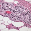 Pancreatic adenocarcinoma invading the peripancreatic fat