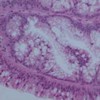 Papillary mucinous adenoma