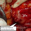 Lateral wall duodenal perforation