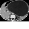 Large post-traumatic pseudocyst.