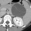 An 8 cm thin-walled, non contrast-enhancing cystic lesion in the pancreatic tail with a hyperdense internal septum