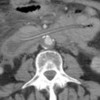 Foley catheter balloon in the duodenum