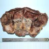 Tumor consisting of polycysts in size varying from 1 mm to 10 cm.