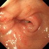 Case of pancreatic head cancer with duodenal invasion