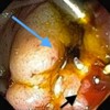 Common bile duct orifice at the ampulla showing yellow bile and pancreatic duct orifice showing red blood