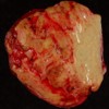 Macro-biopsy obtained from the exploratory laparotomy showing tissue with a yellowish, nodular and polished surface.