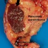 Intrapancreatic accessory spleen.