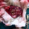 Excised pancreatic pseudocyst of gastrohepatic ligament
