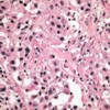 Histology of percutaneous hepatic biopsy showed urothelial carcinoma