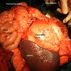 Intra-operative picture of pancreatic mass