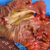 Circumferential fleshy ulcerated tumour