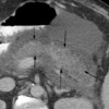 Edematous acute pancreatitis