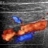 Post anticoagulation therapy status color Doppler shows significant reduction in size of thrombus in left subclavian vein.