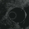 EUS showing a hypoechoic oval mass in the ampulla