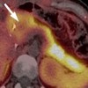 11C-acetate PET/CT scan showing a decreased uptake of the tracer within the pancreatic head