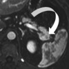 Arciform arterial enhancement at axial arterial-phase contrast enhanced MRI