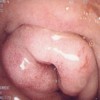 Endoscopic findings of duodenal sub-stenosis