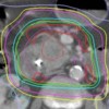 Treatment plan isodose distribution