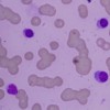 Peripheral blood smear was suggestive of macrocytic anemia with thrombocytopenia and few plasmacytoid lymphocytes.