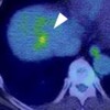 Positron emission tomography revealing a solitary liver metastasis in the right lobe of the liver